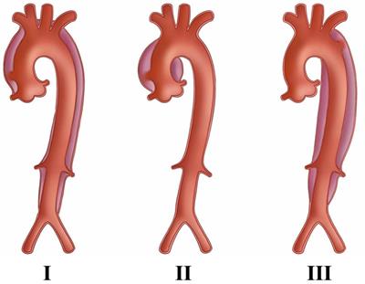 Progress of CT aortic angiography combined with coronary artery in the evaluation of acute aortic syndrome